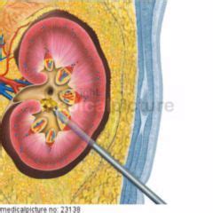 Perkutane Nephrostomie: Anlage einer Nierenfistel